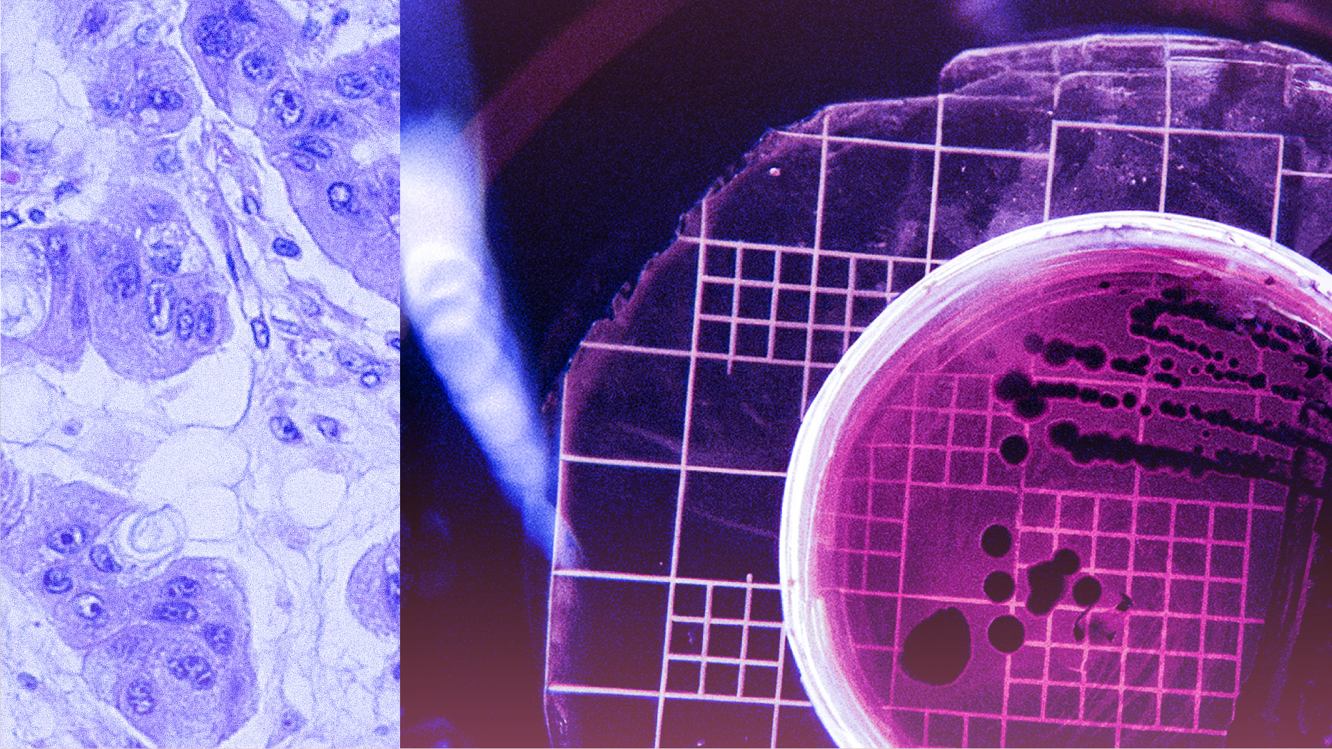 AI Cancer language