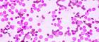 Acute Myeloid Leukaemia cells under a microscope